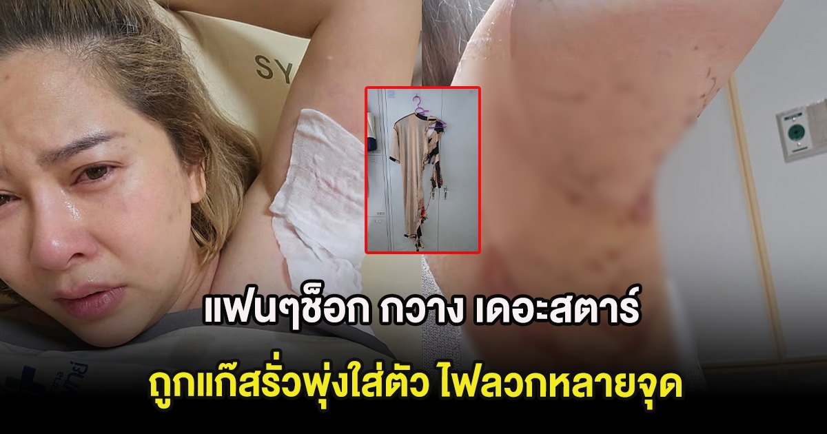 แฟนๆช็อก กวาง เดอะสตาร์ ถูกแก๊สรั่วพุ่งใส่ตัว ไฟลวกหลายจุด