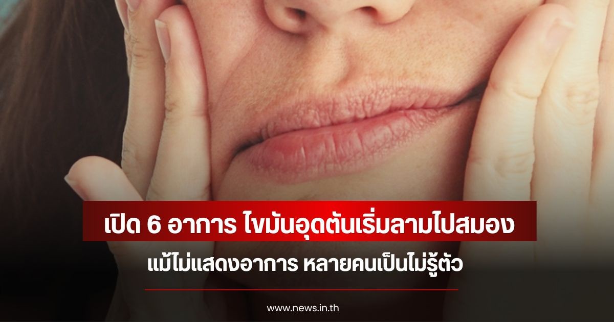เปิด 6 อาการ ไขมันอุดตันเริ่มลามไปสมอง แม้ไม่แสดงอาการ หลายคนเป็นไม่รู้ตัว