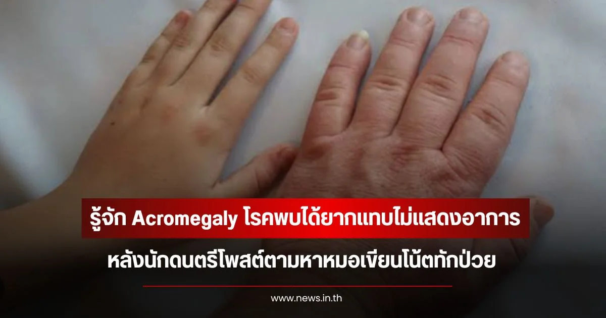 รู้จัก Acromegaly โรคพบได้ยากแทบไม่แสดงอาการ หลังนักดนตรีโพสต์ตามหาหมอเขียนโน้ตทักป่วย