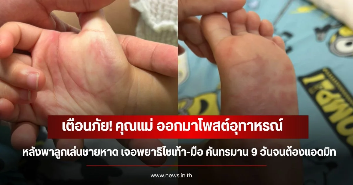 เตือนภัย! คุณแม่ ออกมาโพสต์อุทาหรณ์ หลังพาลูกเล่นชายหาด เจอพยาธิไชเท้า-มือ คันทรมาน 9 วันจนต้องแอดมิท
